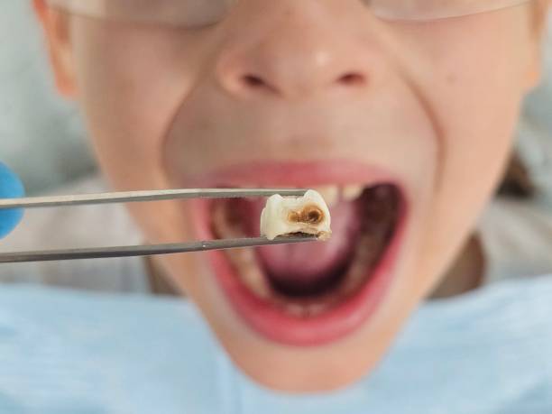 Best Emergency Tooth Extraction in Grand Marais, MN